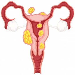 Fibroid